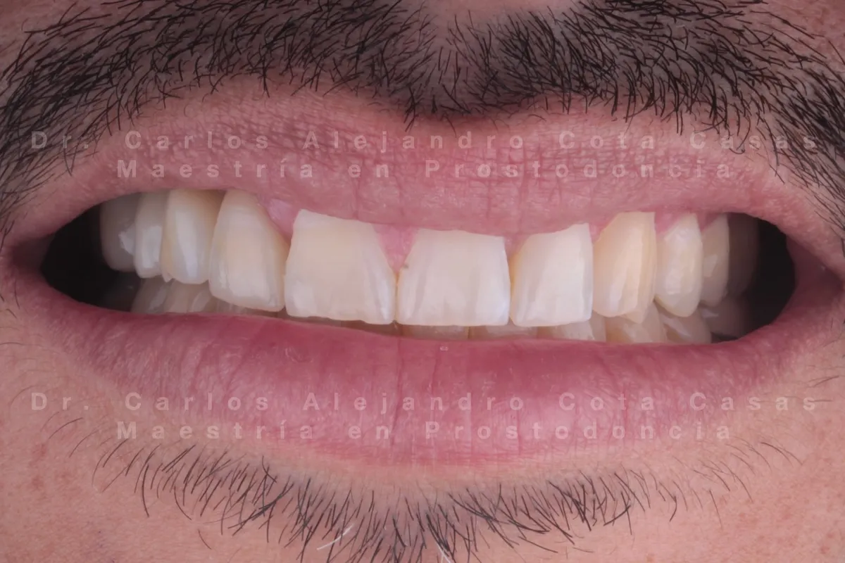 Implantes con injerto óseo y coronas