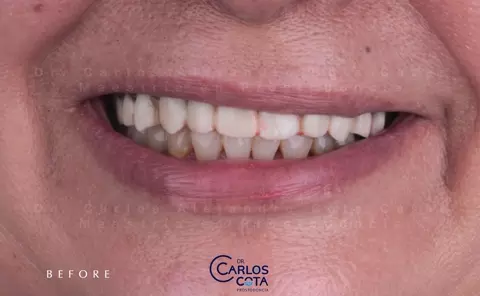Antes: sonrisa