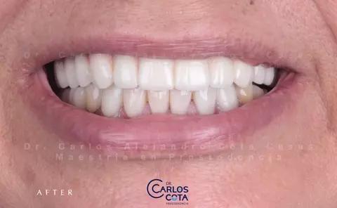 Después: sonrisa