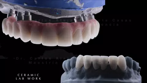 Trabajo de laboratorio: arcada sobre implantes y carillas