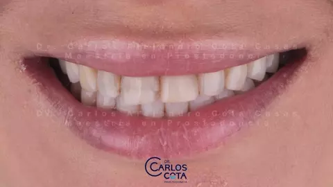 Antes