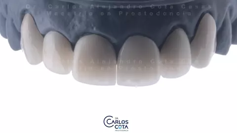 Carillas de porcelana sobre el modelo