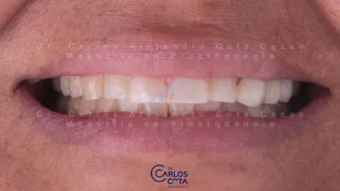 Antes: sonrisa