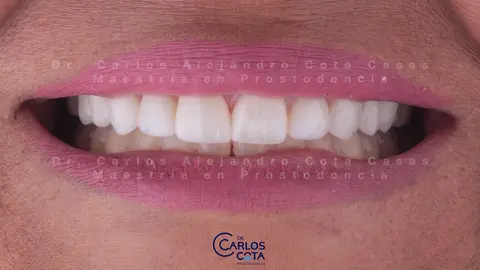 Después: sonrisa