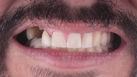 Antes: sonrisa