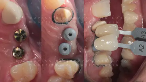 Implantes cicatrizados y elección del color