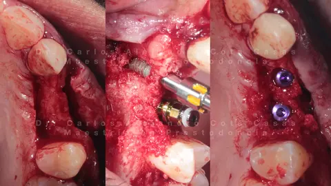 Colocación de los implantes