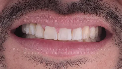 Después: sonrisa