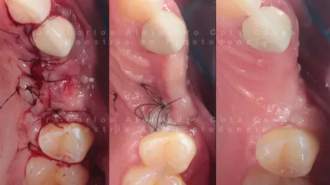 Sutura y cicatrización